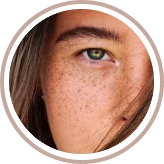 eliminacion de pecas micropigmentacion frekling