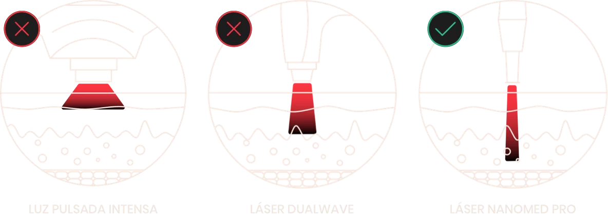 tipos de laser de eliminacion
